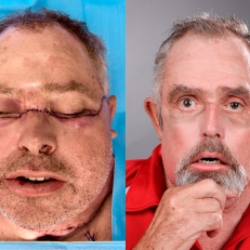 Une première au Canada, une greffe de visage